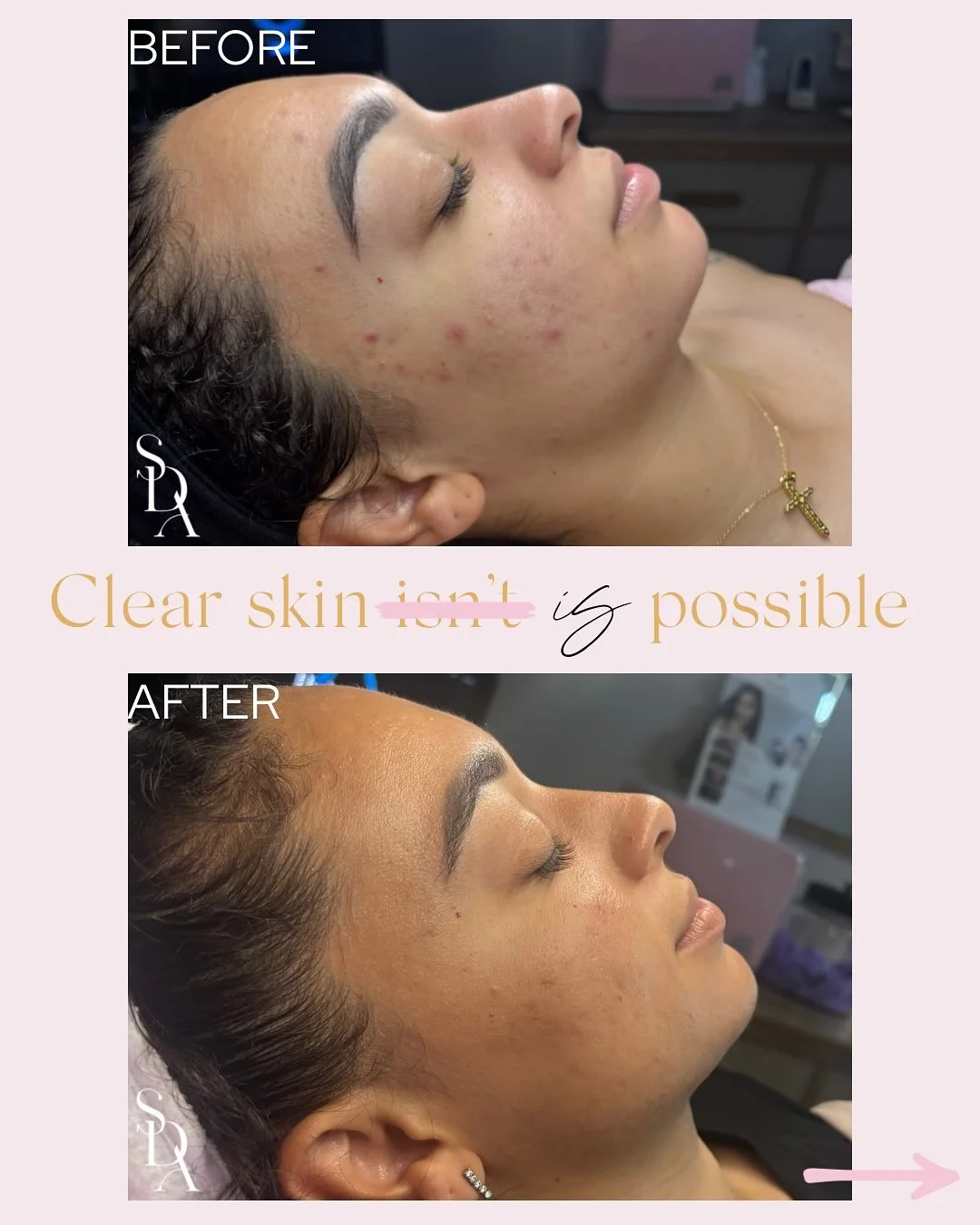 𝗖𝗹𝗲𝗮𝗿 𝘀𝗸𝗶𝗻 𝗜𝗦 𝗽𝗼𝘀𝘀𝗶𝗯𝗹𝗲 &mdash; 𝗲𝘀𝗽𝗲𝗰𝗶𝗮𝗹𝗹𝘆 𝘄𝗵𝗲𝗻 𝘆𝗼𝘂&rsquo;𝗿𝗲 𝗮 𝗰𝗹𝗶𝗲𝗻𝘁 𝗮𝘁 𝗦𝗸𝗶𝗻 𝗗𝗮𝗶𝗹𝘆 𝗔𝗲𝘀𝘁𝗵𝗲𝘁𝗶𝗰𝘀!💖

My beautiful client has achieved clear skin through consistent monthly treatments (Hyd