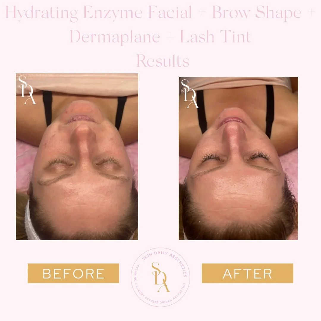 𝗚𝗹𝗼𝘄𝗶𝗻𝗴 𝘀𝗸𝗶𝗻, 𝗱𝗲𝗳𝗶𝗻𝗲𝗱 𝗯𝗿𝗼𝘄𝘀, 𝗮𝗻𝗱 𝗯𝗼𝗹𝗱 𝗹𝗮𝘀𝗵𝗲𝘀 &mdash; 𝘁𝗵𝗶𝘀 𝘁𝗿𝗮𝗻𝘀𝗳𝗼𝗿𝗺𝗮𝘁𝗶𝗼𝗻 𝘀𝗮𝘆𝘀 𝗶𝘁 𝗮𝗹𝗹!💖

Our Hydrating Enzyme Facial with a Dermaplane, Brow Shape, and Lash Tint left my beautiful clients