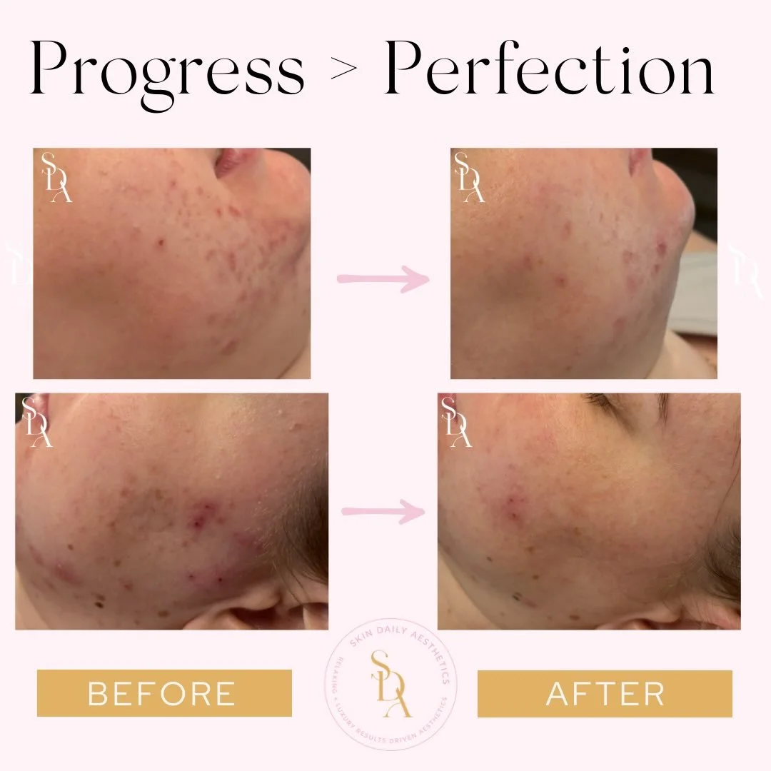 𝗣𝗿𝗼𝗴𝗿𝗲𝘀𝘀 𝗼𝘃𝗲𝗿 𝗽𝗲𝗿𝗳𝗲𝗰𝘁𝗶𝗼𝗻. 𝗥𝗲𝗮𝗹 𝘀𝗸𝗶𝗻. 𝗥𝗲𝗮𝗹 𝗽𝗿𝗼𝗴𝗿𝗲𝘀𝘀. 

Acne healing isn&rsquo;t overnight &mdash; it&rsquo;s a journey, and every breakout healed is a win. So proud of this consistency and the commitment behin