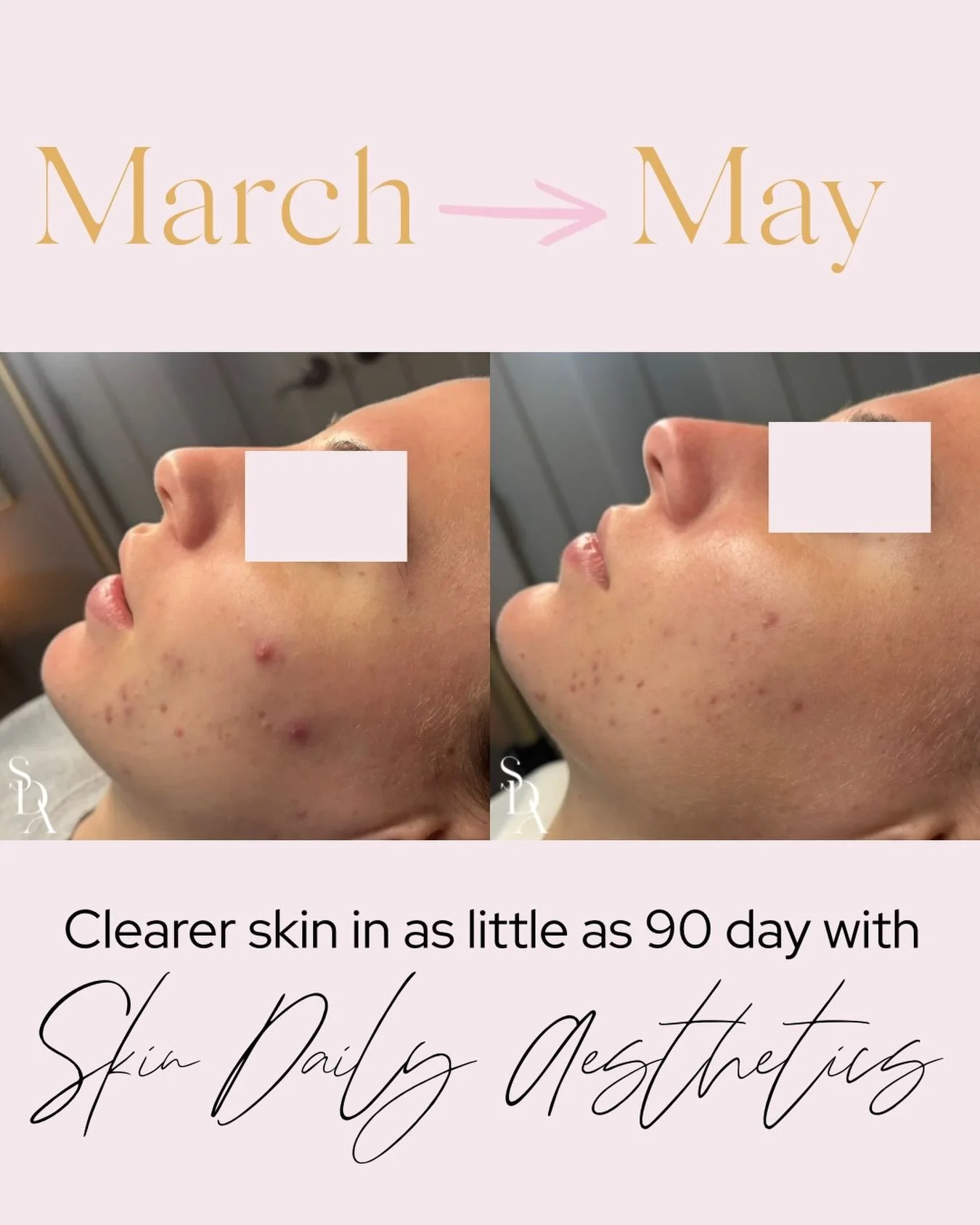 𝗧𝗵𝗶𝘀 𝗶𝘀 𝘆𝗼𝘂𝗿 𝗿𝗲𝗺𝗶𝗻𝗱𝗲𝗿 𝘁𝗵𝗮𝘁 𝗮𝗰𝗻𝗲 𝗱𝗼𝗲𝘀𝗻&rsquo;𝘁 𝗰𝗹𝗲𝗮𝗿 𝗼𝘃𝗲𝗿𝗻𝗶𝗴𝗵𝘁&mdash;𝗯𝘂𝘁 𝘄𝗶𝘁𝗵 𝘁𝗵𝗲 𝗿𝗶𝗴𝗵𝘁 𝗽𝗹𝗮𝗻, 𝙞𝙩 𝙙𝙤𝙚𝙨!✨

In just 90 days, we focused on consistency, customized treatments, and targ