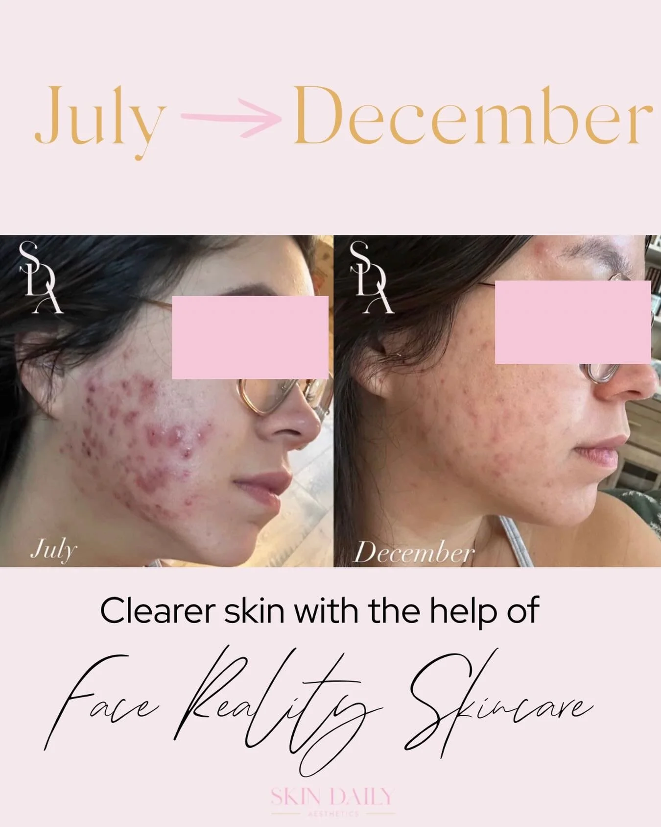 This beautiful client achieved these amazing results with the help of a customized routine from 𝗦𝗸𝗶𝗻 𝗗𝗮𝗶𝗹𝘆 𝗔𝗲𝘀𝘁𝗵𝗲𝘁𝗶𝗰𝘀 using 𝗙𝗮𝗰𝗲 𝗥𝗲𝗮𝗹𝗶𝘁𝘆 𝗦𝗸𝗶𝗻𝗰𝗮𝗿𝗲!💖

Acne isn&rsquo;t random&mdash;and clearing it isn&rsquo;t eith