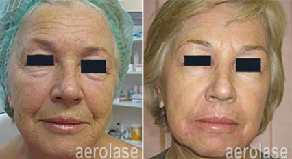 Side-by-side comparison of a woman's face before and after a cosmetic procedure showing smoother skin and reduced wrinkles.
