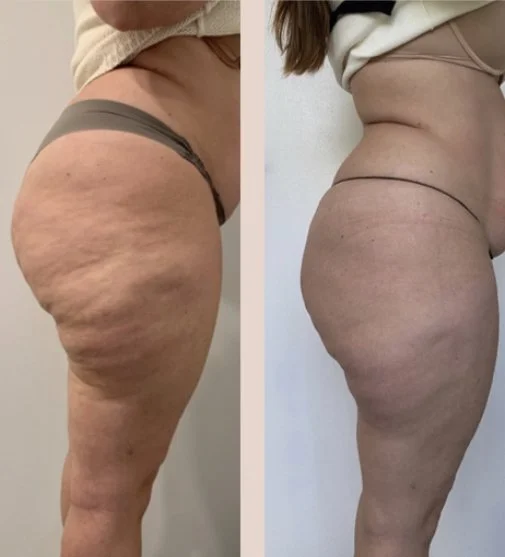 12 sessions (side), Endo Body.JPEG