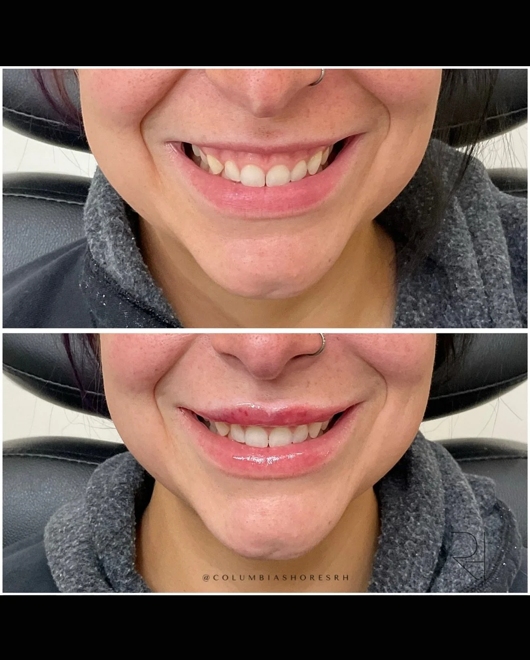 💋 Pout goals, unlocked.
These lip filler transformations? Chef&rsquo;s kiss. 👄✨ Subtle volume, natural balance, and results that scream you, but fresher.

We&rsquo;re still buzzing from the energy of Confidence at the Club yesterday (you all brough