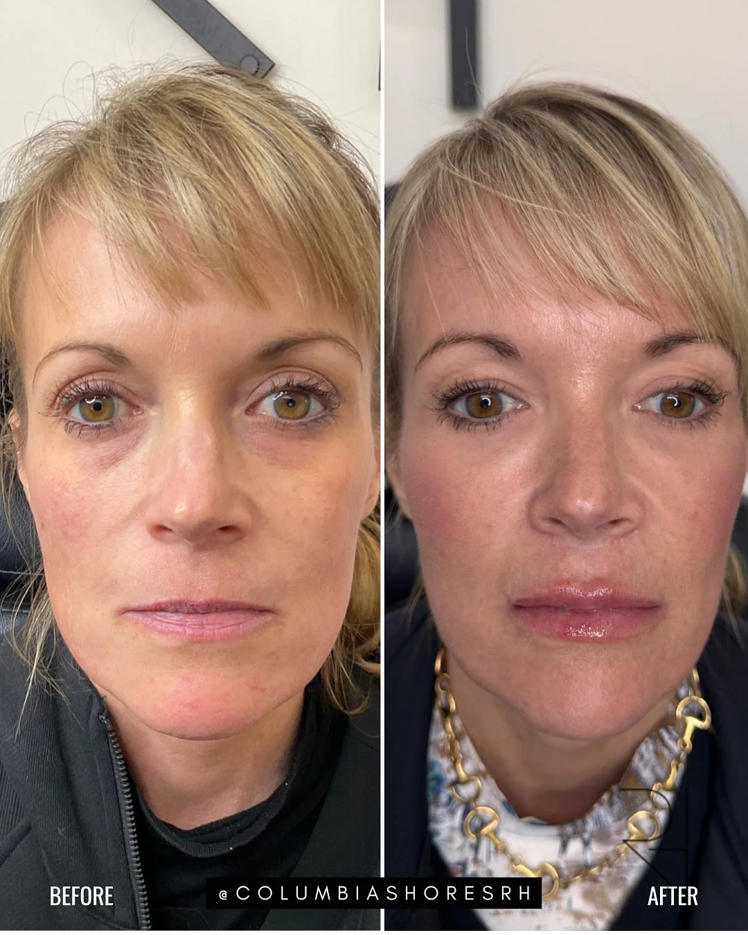 Meet the power of biostimulators.

After weight loss or with age, it&rsquo;s normal to lose facial volume &mdash; but that doesn&rsquo;t mean you need traditional filler to get it back. Treatments like Sculptra use your body&rsquo;s own collagen-buil