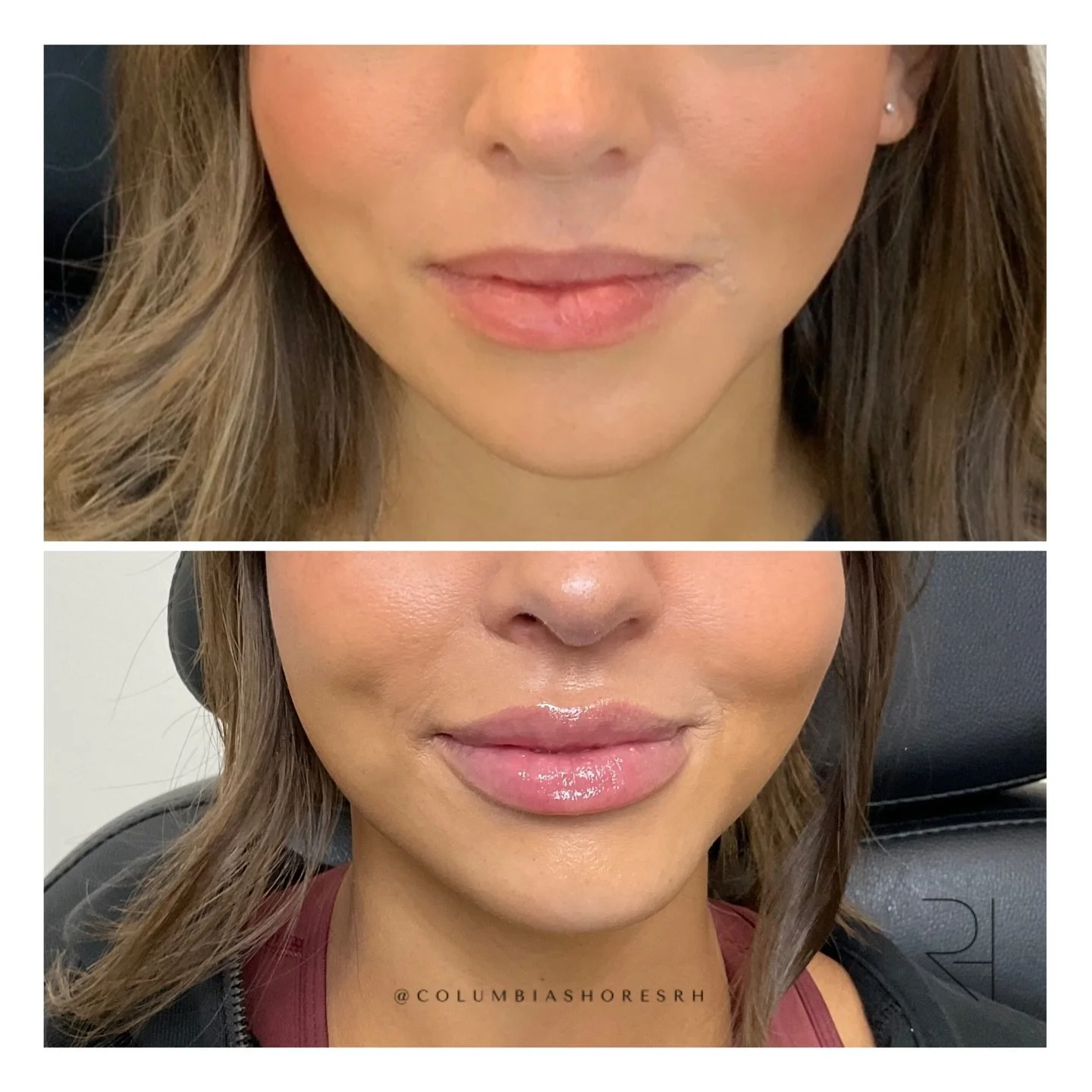 ✨ Subtle. Timeless. Beautiful. ✨
Great lip filler isn&rsquo;t about trends &mdash; it&rsquo;s about balance, structure, and a result that still feels like you. When done thoughtfully, your lip enhancement can age gracefully and last for years, buildi
