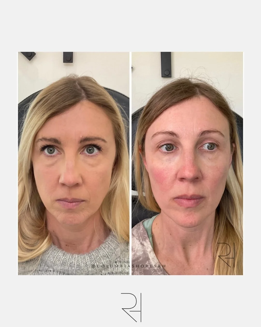 This is what volume restoration should look like.

Not overdone.
Not obvious.
Not trying too hard.

Just&hellip; supported.

Because as volume shifts over time, it&rsquo;s not always about lines, it&rsquo;s about structure.

When we restore that stru