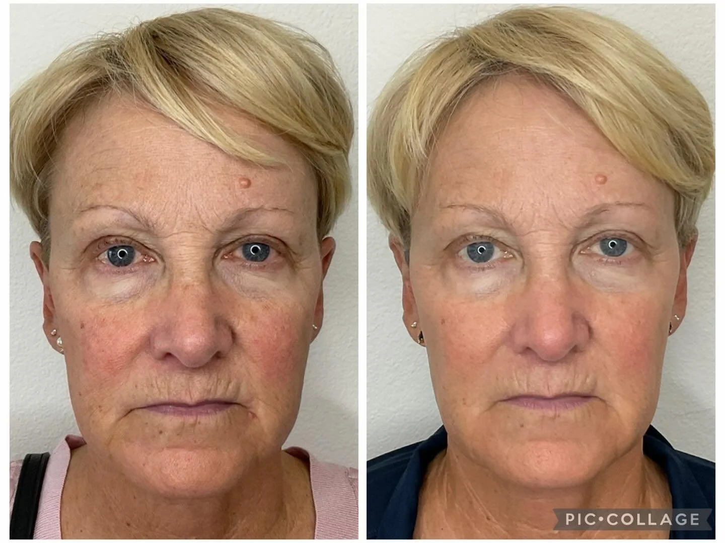 This is what we mean by natural, noticeable results.
No heavy filters.
No overdone look.
Just healthier, brighter, smoother skin.

MOXI + BBL works by targeting pigment, sun damage, and texture&mdash;while stimulating collagen underneath.

It&rsquo;s