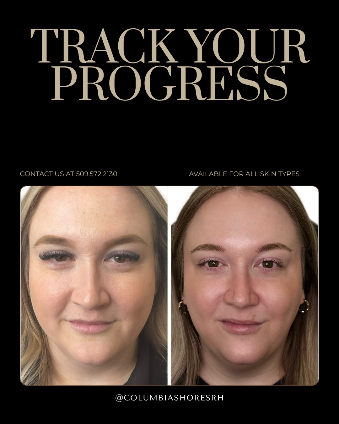 Track Skin Progress with VISIA