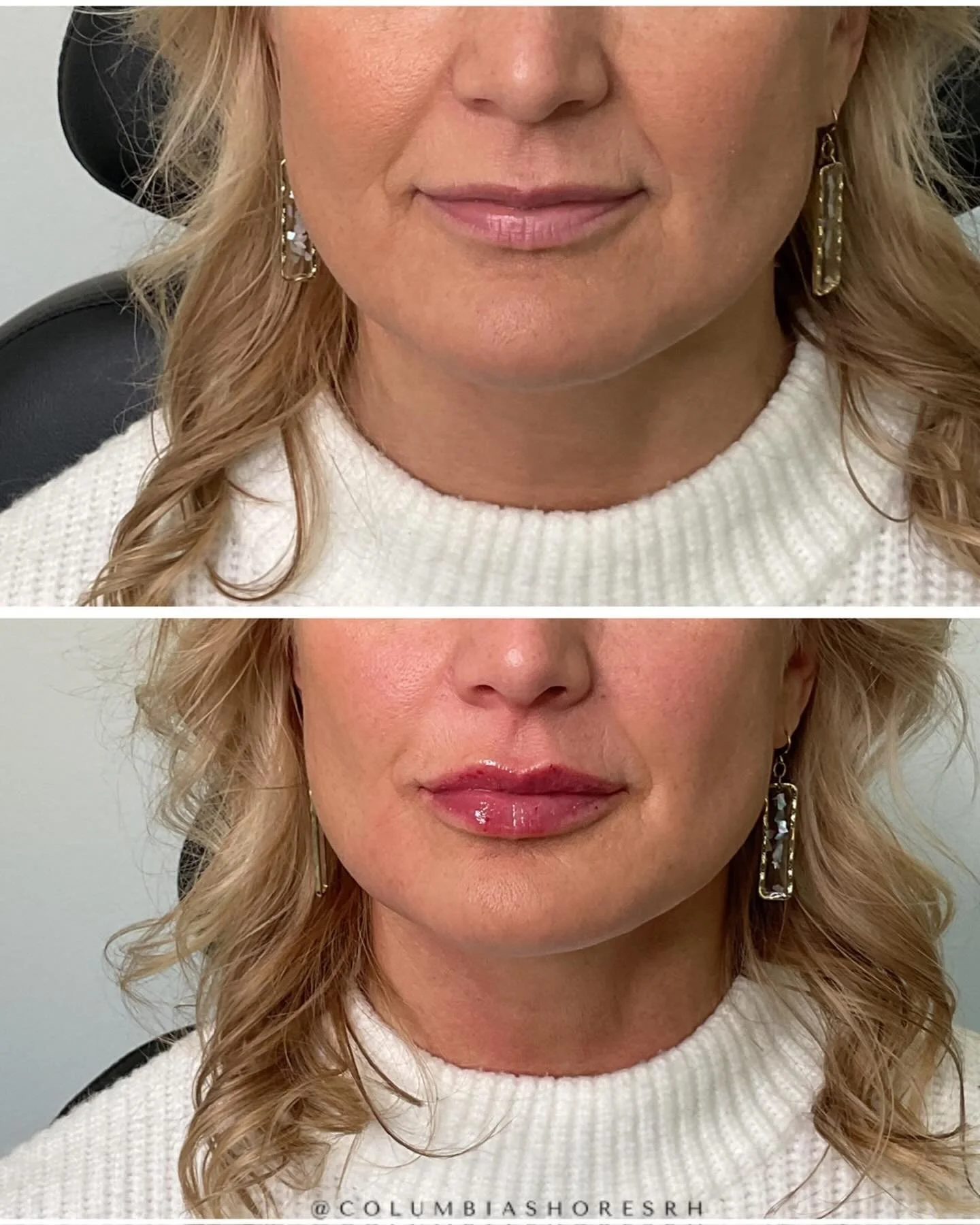 The best lip filler is the kind where people notice you look GOOD&hellip;
but can&rsquo;t quite figure out why. 👏

No migration.
No overfilled &ldquo;pillow face.&rdquo;
No copy-paste lips.

Just:
✨ hydration
✨ balance
✨ soft volume
✨ structure
✨ co
