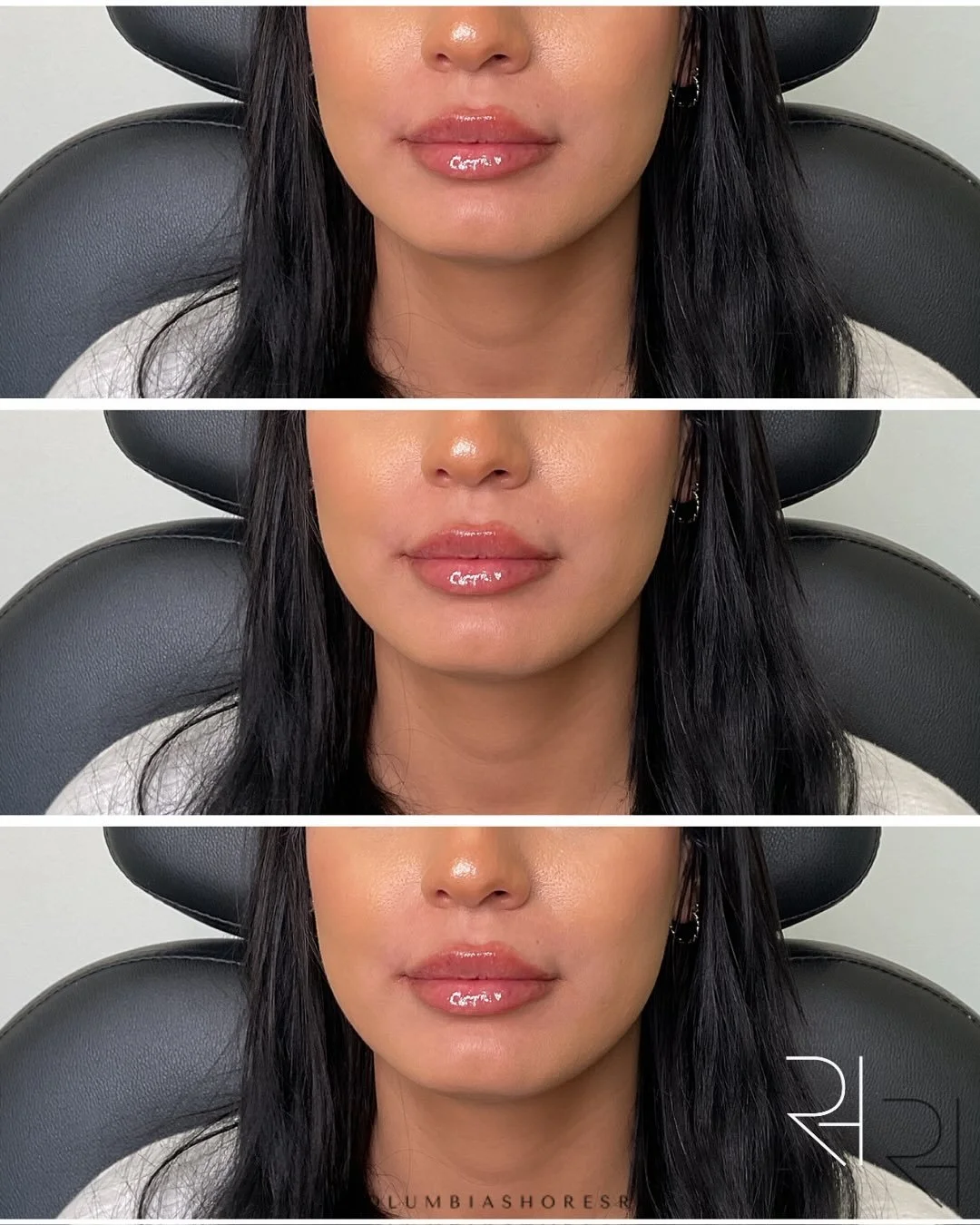 No two sets of lips are the same, and that&rsquo;s exactly why no two treatments should be either. 🤍💋

Swipe through to see real patient transformations, each designed around each person&rsquo;s natural features and aesthetic goals.

Whether the go