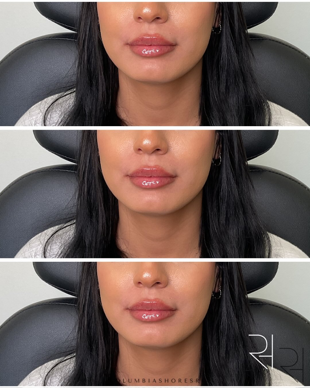 No two sets of lips are the same, and that&rsquo;s exactly why no two treatments should be either. 🤍💋

Swipe through to see real patient transformations, each designed around each person&rsquo;s natural features and aesthetic goals.

Whether the go