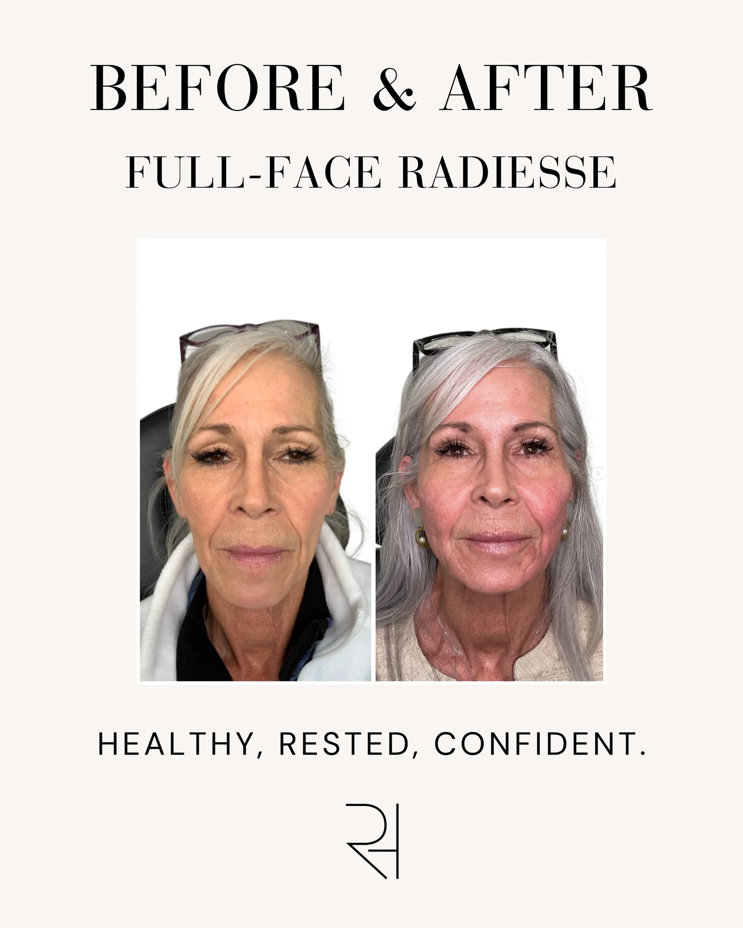 Sometimes the most beautiful results are the ones that simply help you look like yourself, just refreshed. Almost like you&rsquo;ve been getting full nights of sleep for the whole month!

This full-face treatment was thoughtfully customized to restor