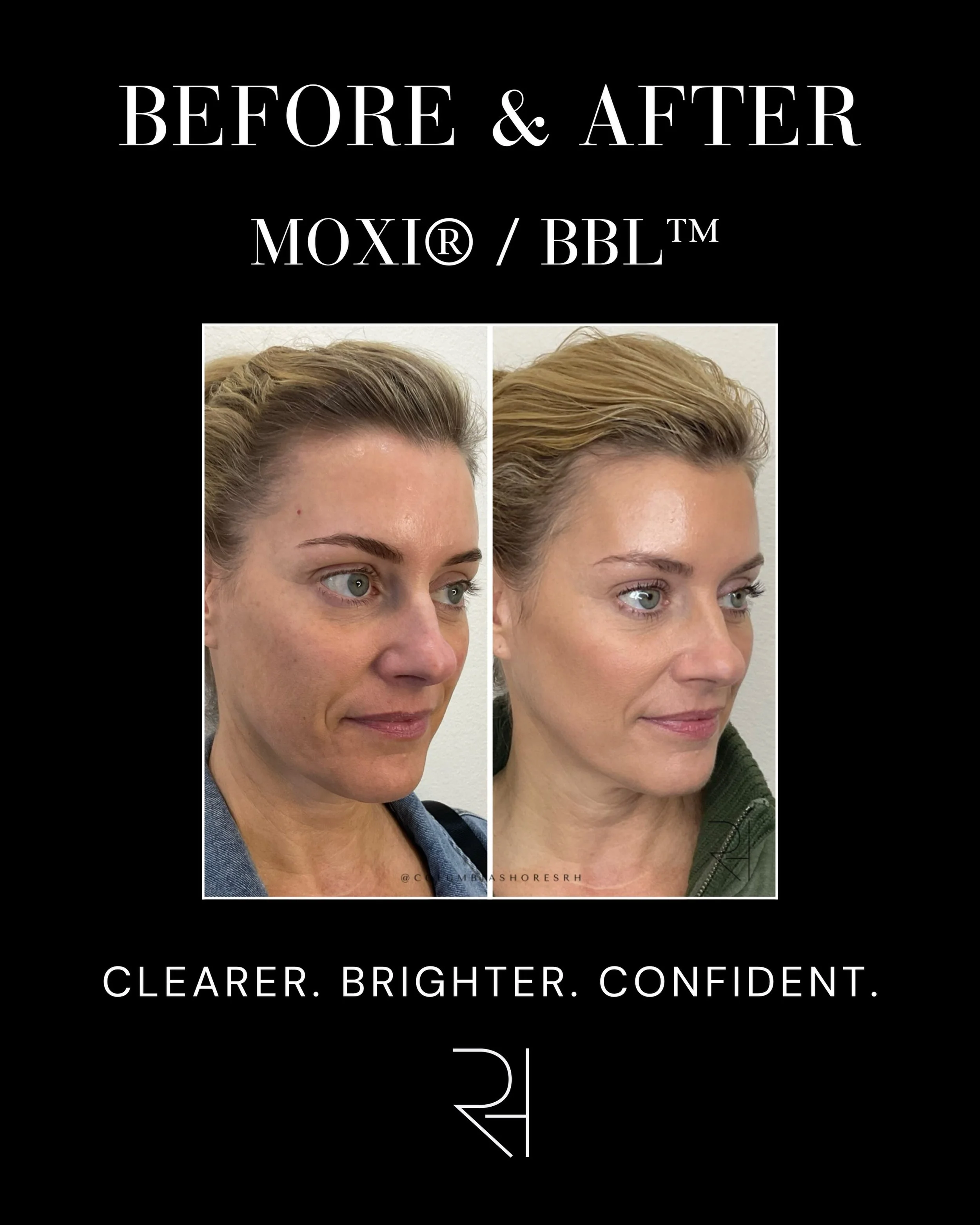 This before &amp; after showcases the power of combining MOXI + BBL to address:

-Sun damage
-Uneven skin tone
-Pigmentation
-Redness
-Overall skin texture

The goal with this treatment is to restore a brighter, healthier, more even complexion. ✨👏🏻