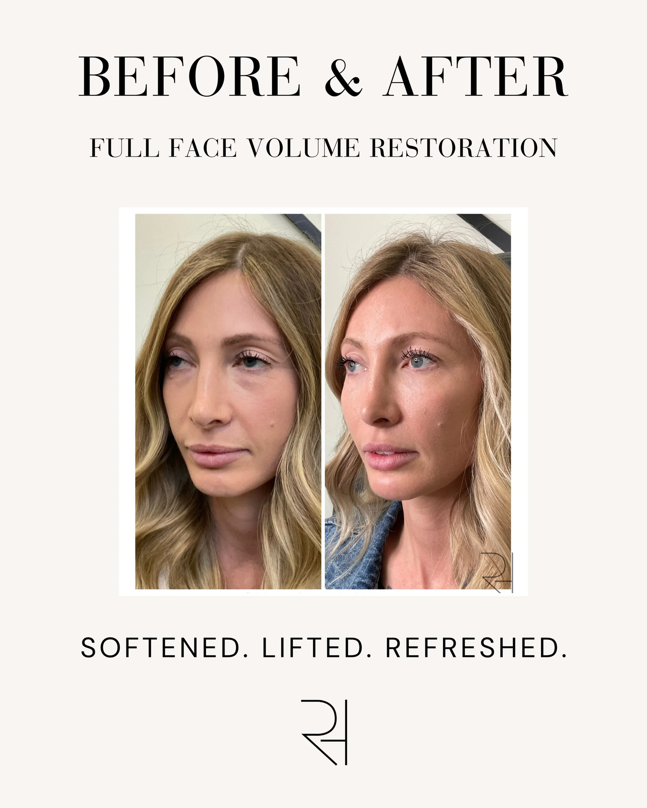 Beautiful results begin with seeing the full picture. ✨

For this client, Rachel created a personalized full-face plan designed to restore balance and refresh the overall appearance!

At Columbia Shores, every full-face plan begins with a conversatio
