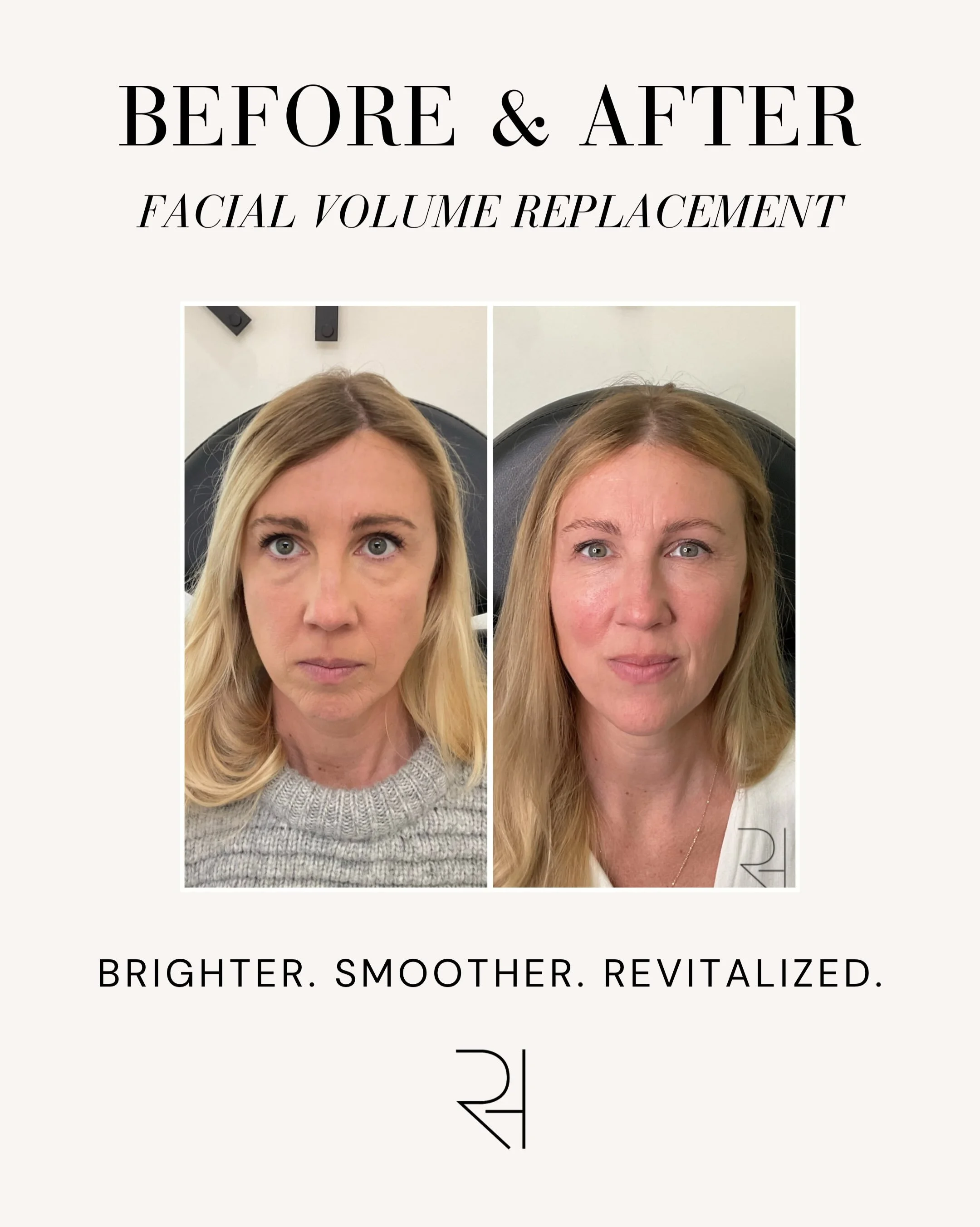 A subtle refresh can make such a beautiful difference. ✨

Facial volume replacement helps restore fullness and soften the appearance of hollowing, creating a refreshed look that still feels like you.

Every face is unique, and the right approach depe