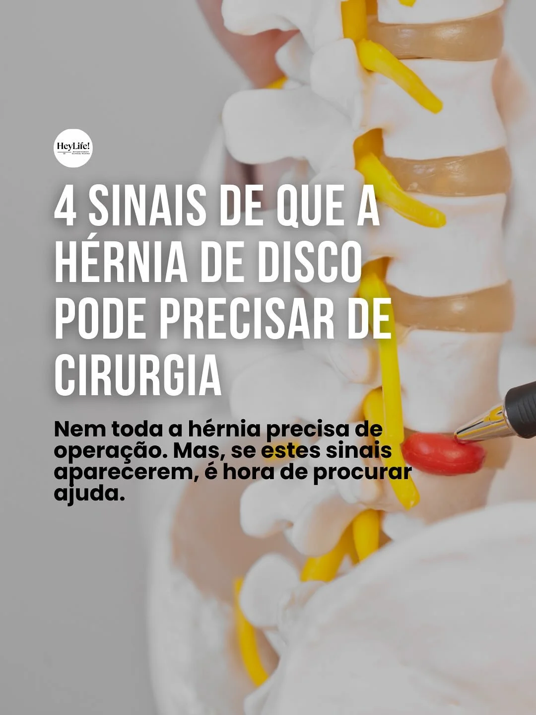 Muitas pessoas entram na cl&iacute;nica com medo de precisar de cirurgia por causa da h&eacute;rnia de disco&hellip; mas a verdade &eacute; que, na maioria dos casos, isso n&atilde;o &eacute; necess&aacute;rio!

O tratamento com fisioterapia e exerc&