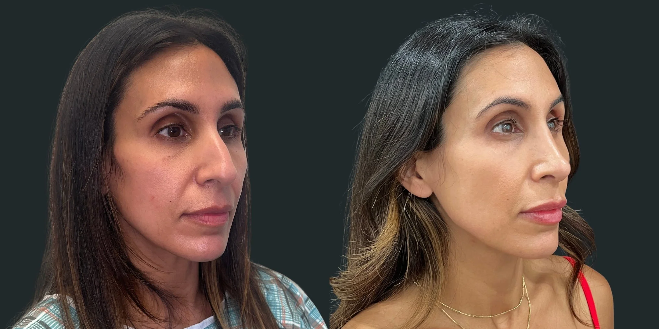 dr-michael-omidi-before-and-after-photo-of-client-rhinoplasty (4).jpg