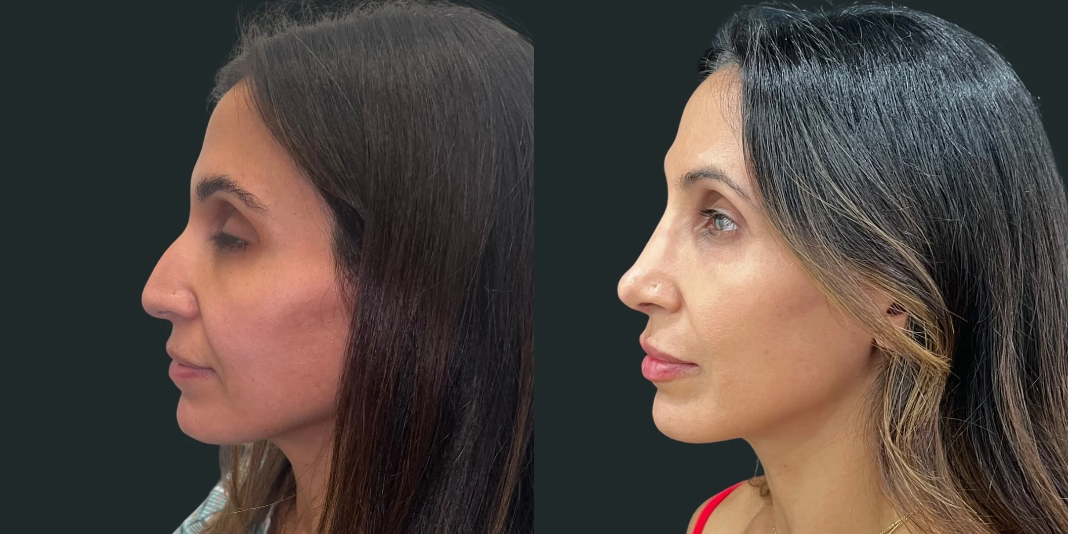dr-michael-omidi-before-and-after-photo-of-client-rhinoplasty.jpg