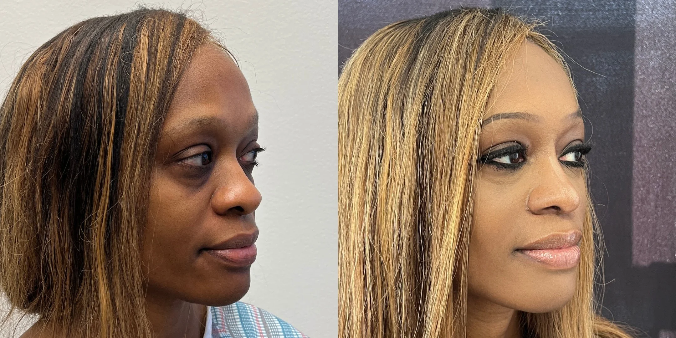 dr-michael-omidi-before-and-after-photo-of-client (4).jpg