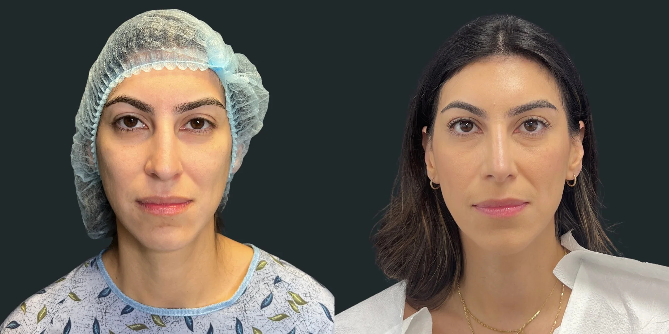 dr-michael-omidi-before-and-after-photo-of-client-rhinoplasty.jpg