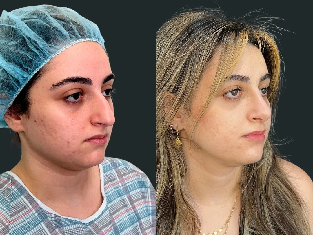 dr-michael-omidi-rhinoplasty-results-6-weeks-post-op- beverly-hills-los-angeles (2).jpg
