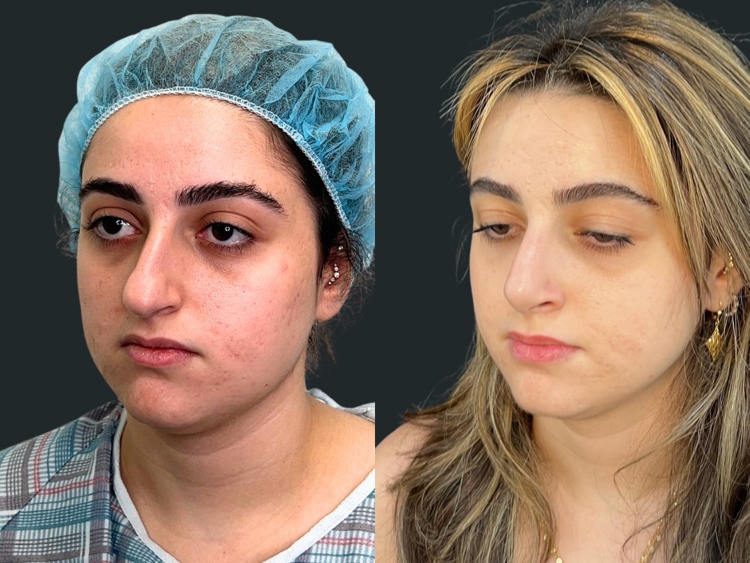 dr-michael-omidi-rhinoplasty-results-6-weeks-post-op- beverly-hills-los-angeles (4).jpg