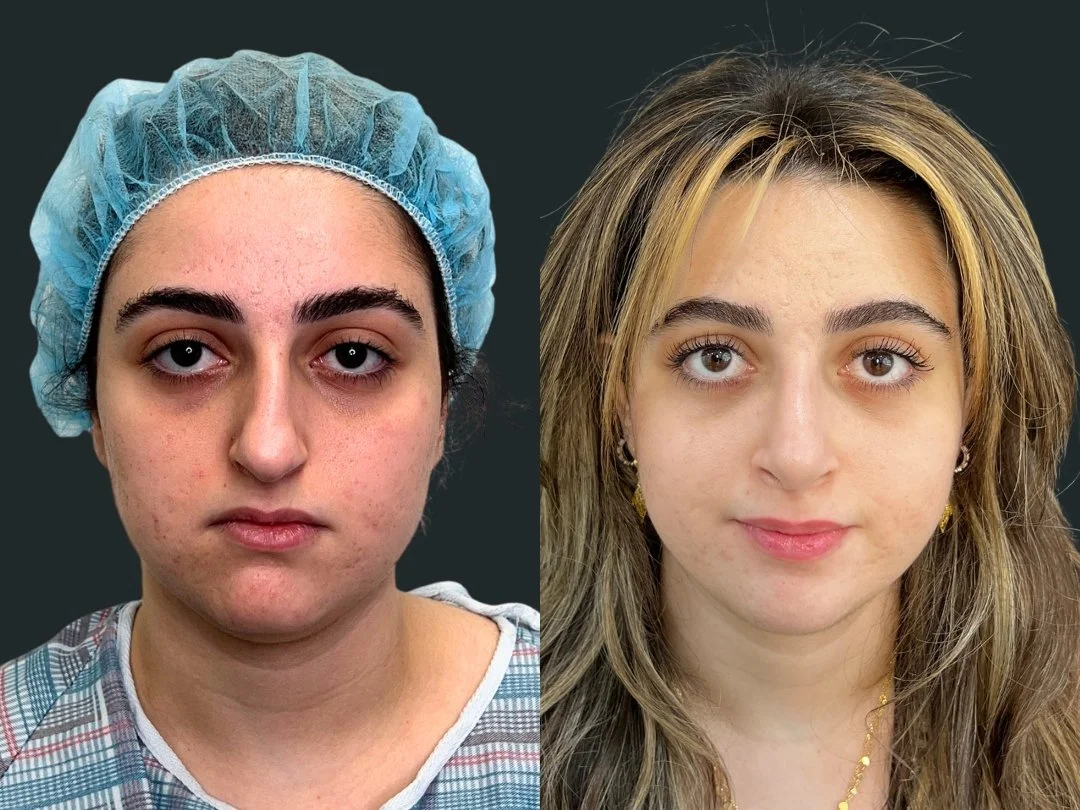 dr-michael-omidi-rhinoplasty-results-6-weeks-post-op- beverly-hills-los-angeles (3).jpg