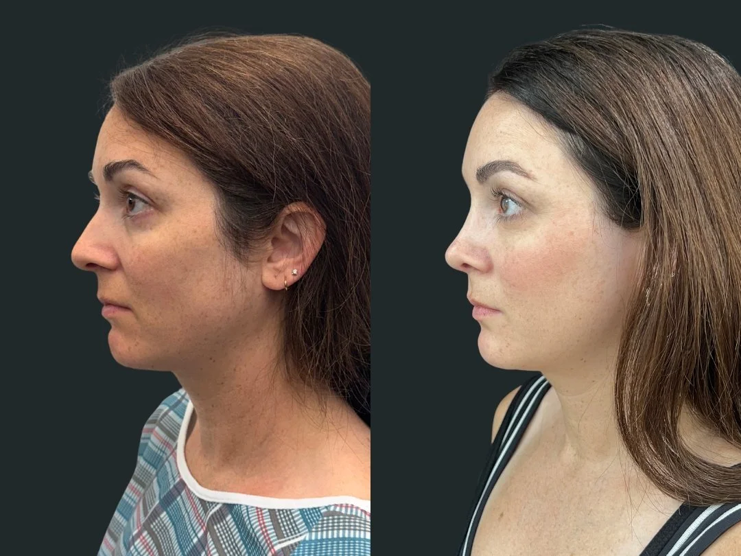 dr-michael-omidi-rhinoplasty-results-3-months-post-op- beverly-hills-california (3).jpg