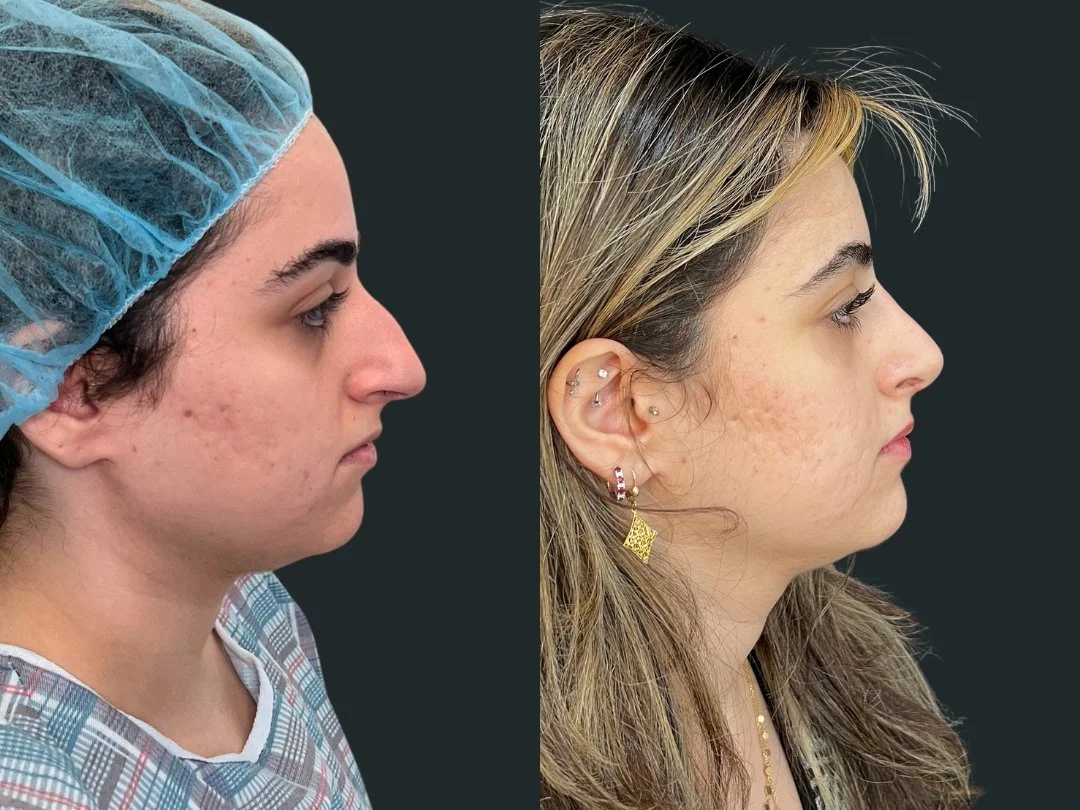 dr-michael-omidi-rhinoplasty-results-6-weeks-post-op- beverly-hills-los-angeles.jpg