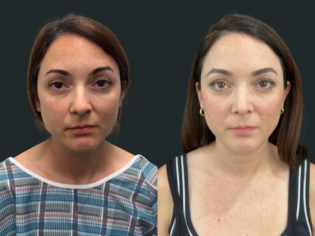 dr-michael-omidi-rhinoplasty-results-3-months-post-op- beverly-hills-california (5).jpg