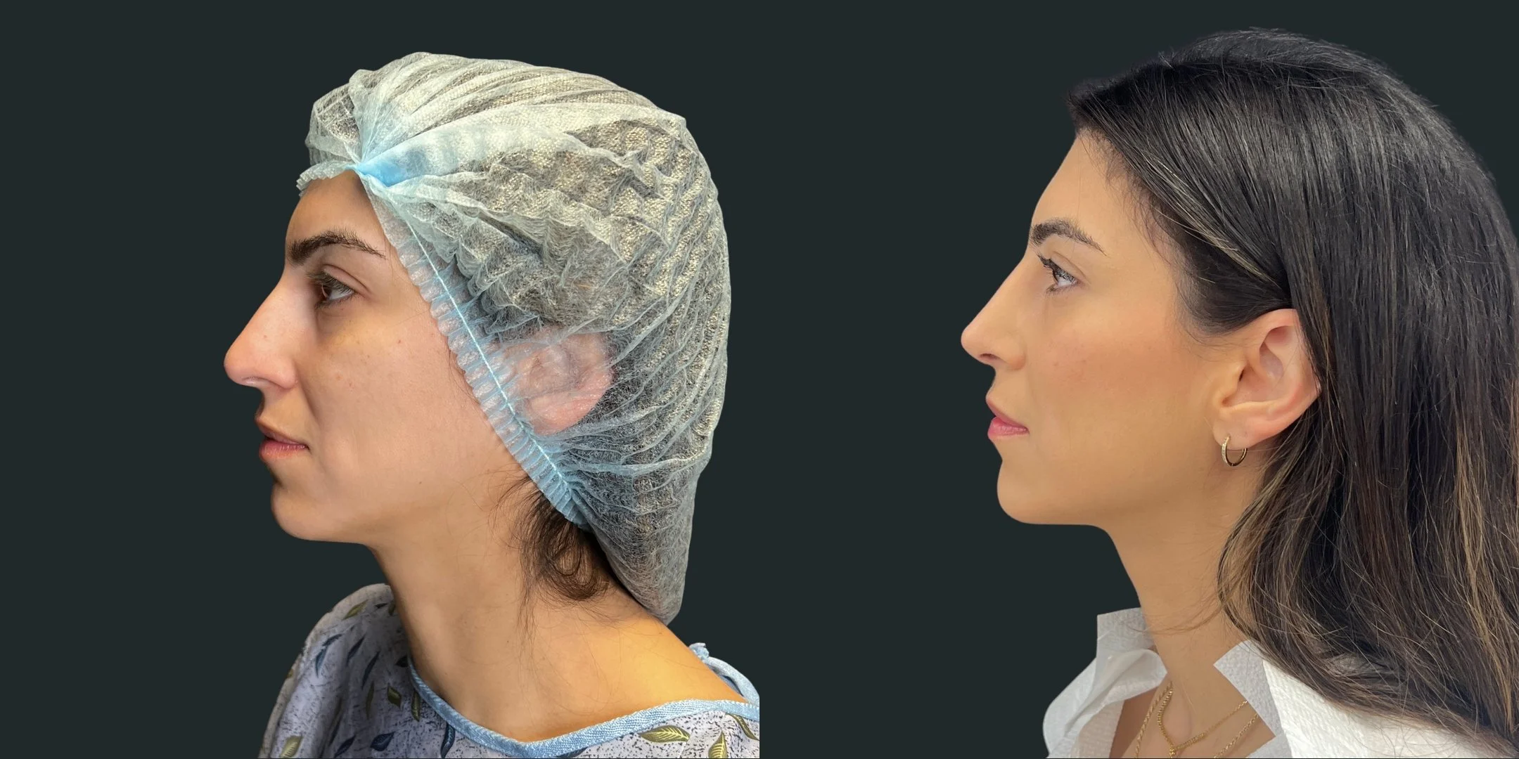 dr-michael-omidi-before-and-after-photo-of-client-rhinoplasty (5).jpg