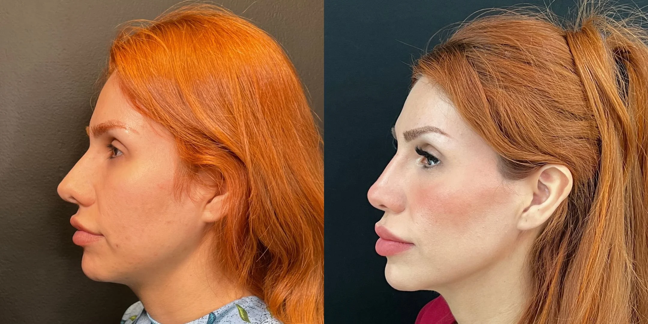 dr-michael-omidi-before-and-after-photo-of-client-revision-rhinoplasty.jpg