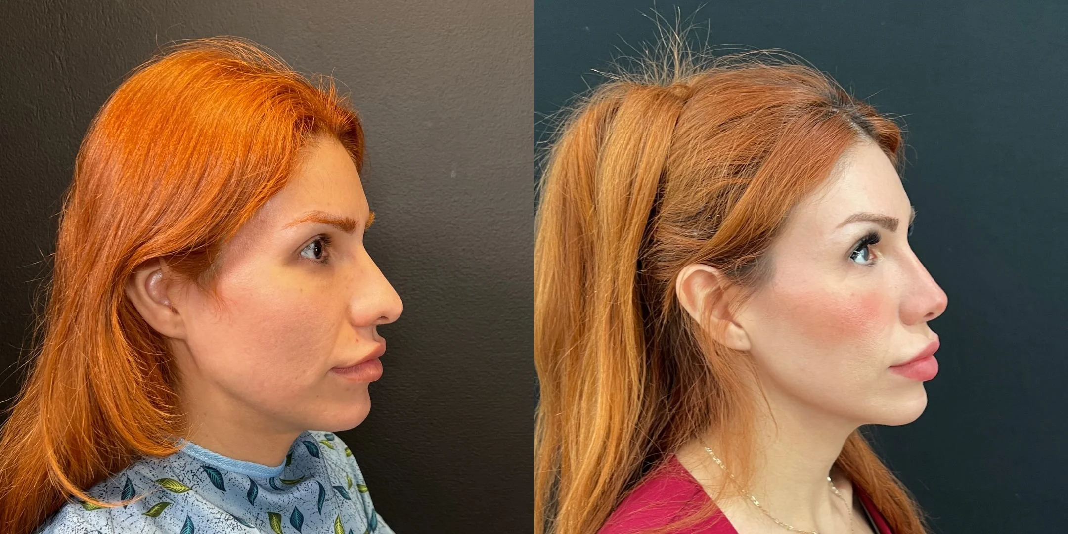 dr-michael-omidi-before-and-after-photo-of-client-revision-rhinoplasty (5).jpg