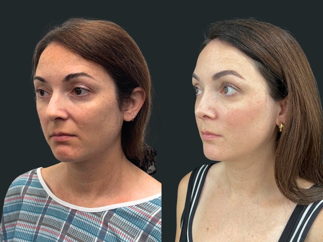 dr-michael-omidi-rhinoplasty-results-3-months-post-op- beverly-hills-california (4).jpg