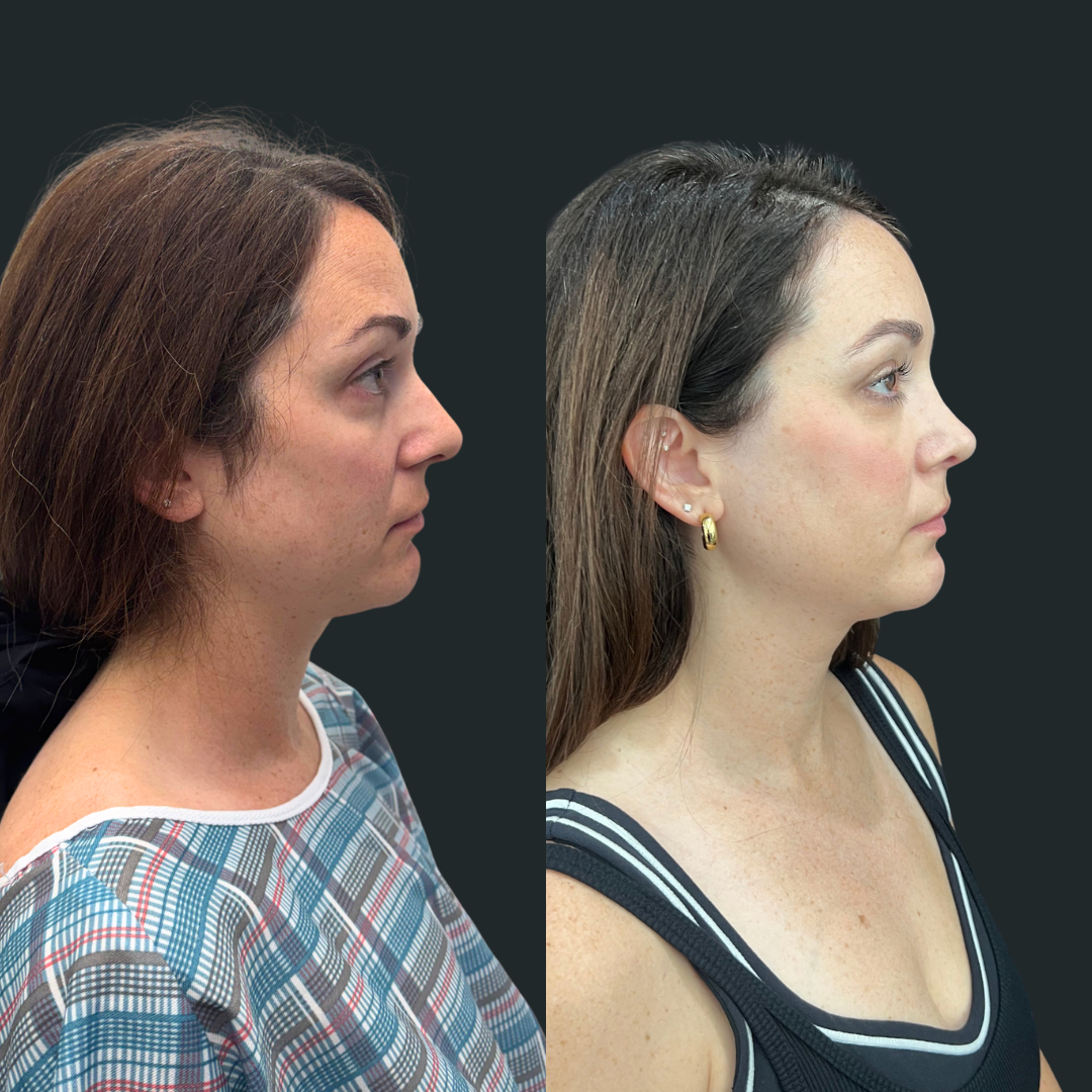 Rhinoplasty Case #101426-1