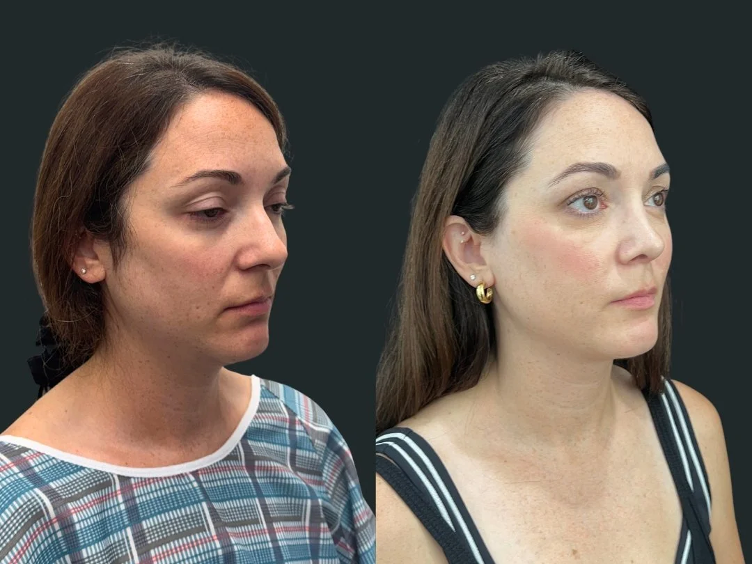 dr-michael-omidi-rhinoplasty-results-3-months-post-op- beverly-hills-california (2).jpg