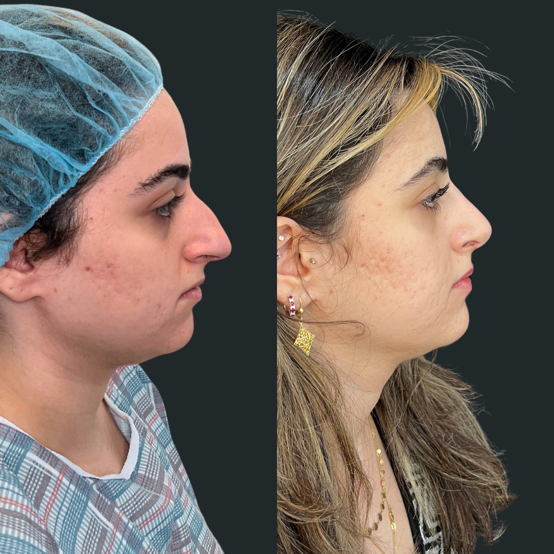 Rhinoplasty Case #101426-2