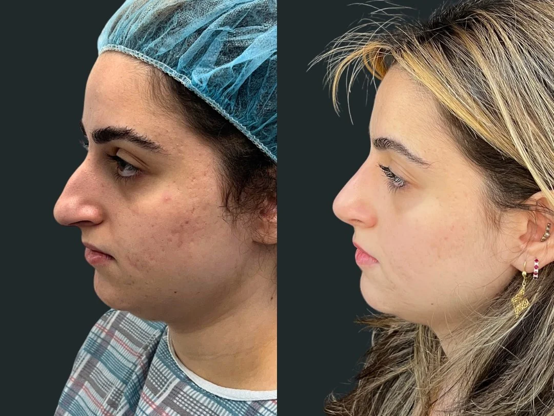 dr-michael-omidi-rhinoplasty-results-6-weeks-post-op- beverly-hills-los-angeles (5).jpg