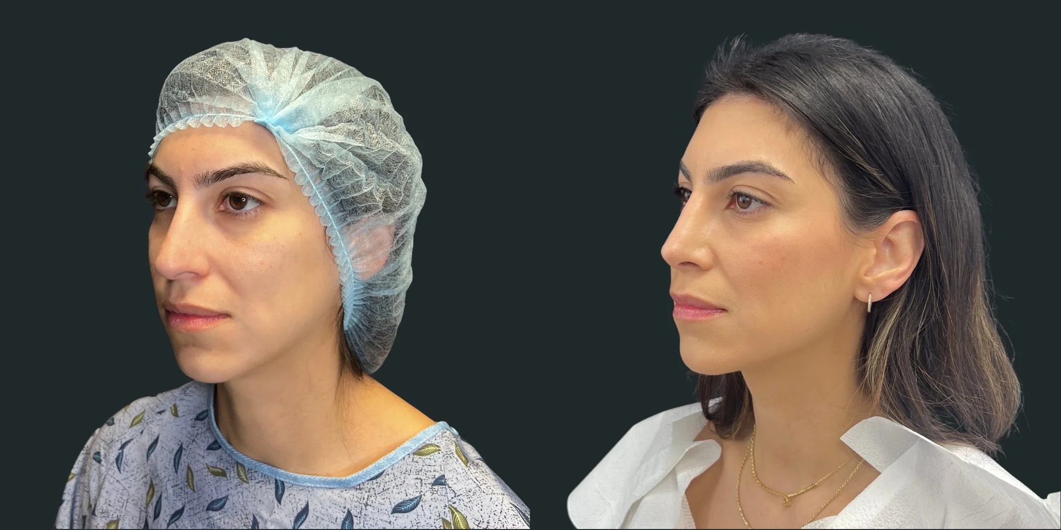 dr-michael-omidi-before-and-after-photo-of-client-rhinoplasty (4).jpg