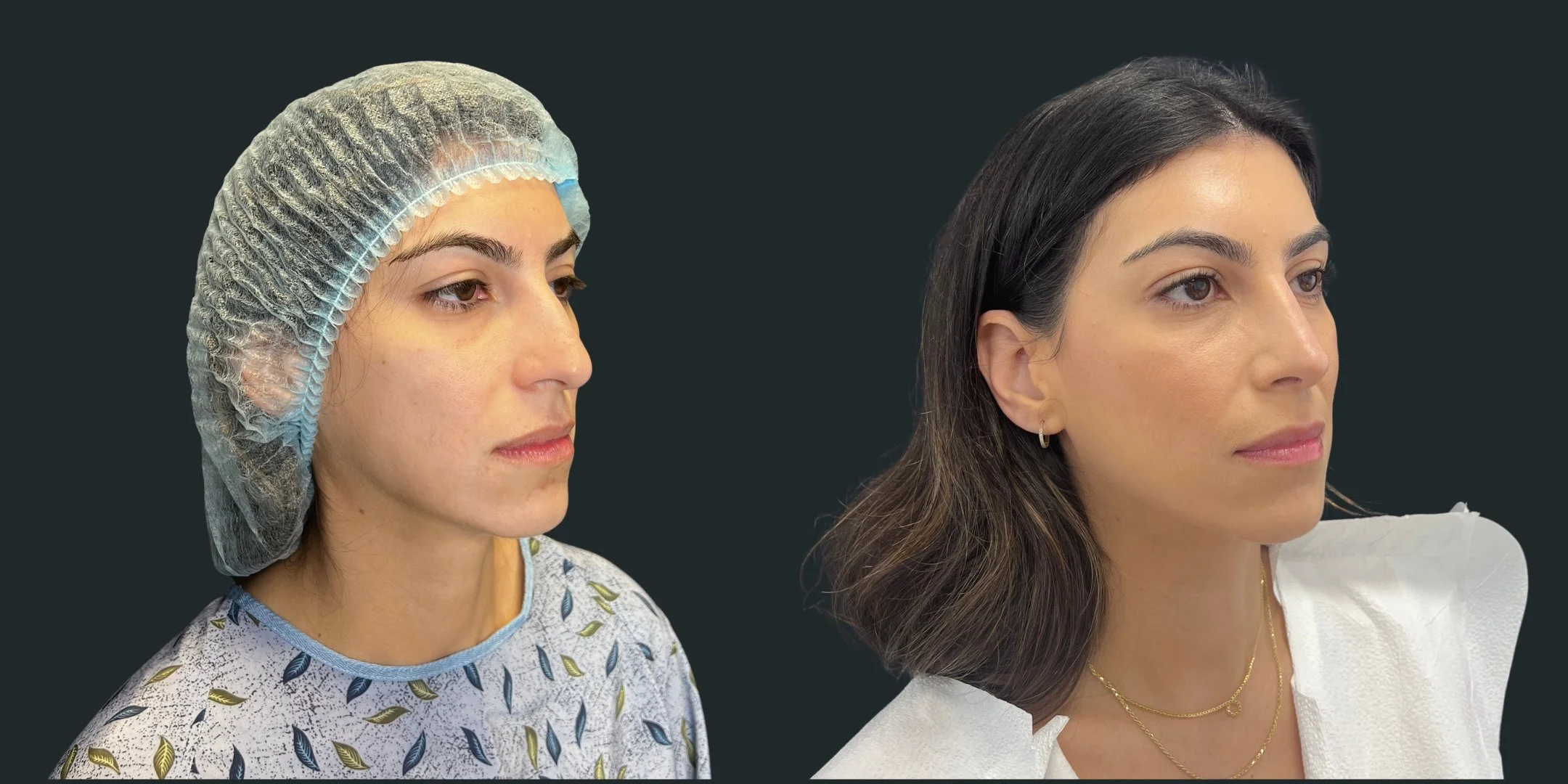 dr-michael-omidi-before-and-after-photo-of-client-rhinoplasty (2).jpg
