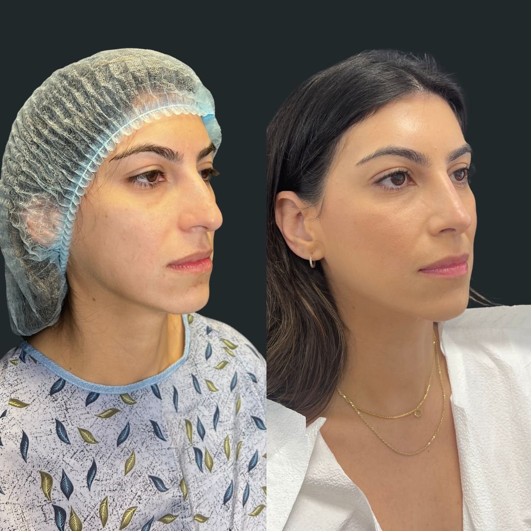 Rhinoplasty Case #91426-1