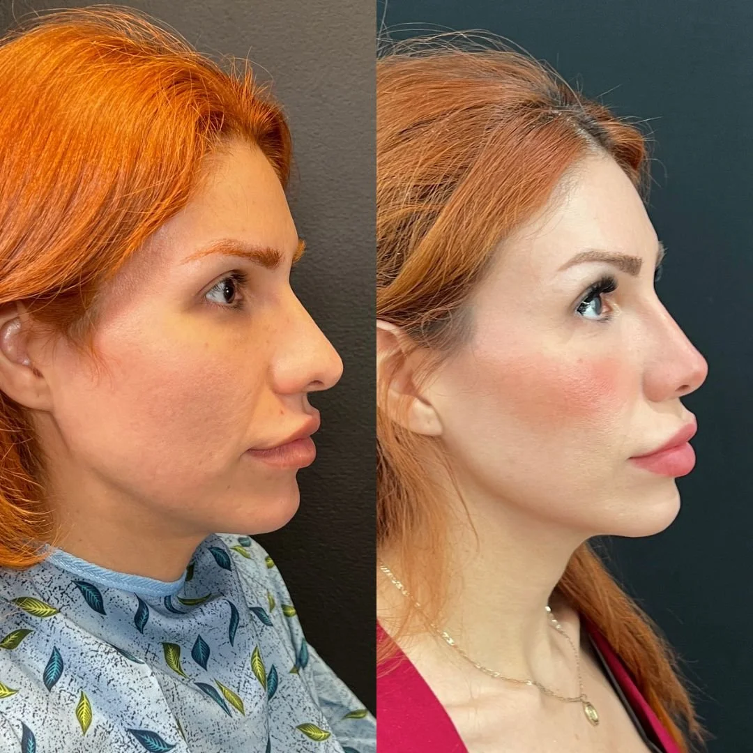 Rhinoplasty Case #82126-2