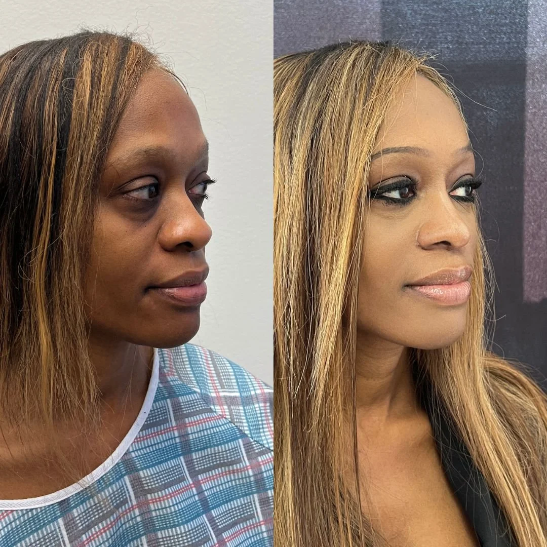 Rhinoplasty Case #82126-1