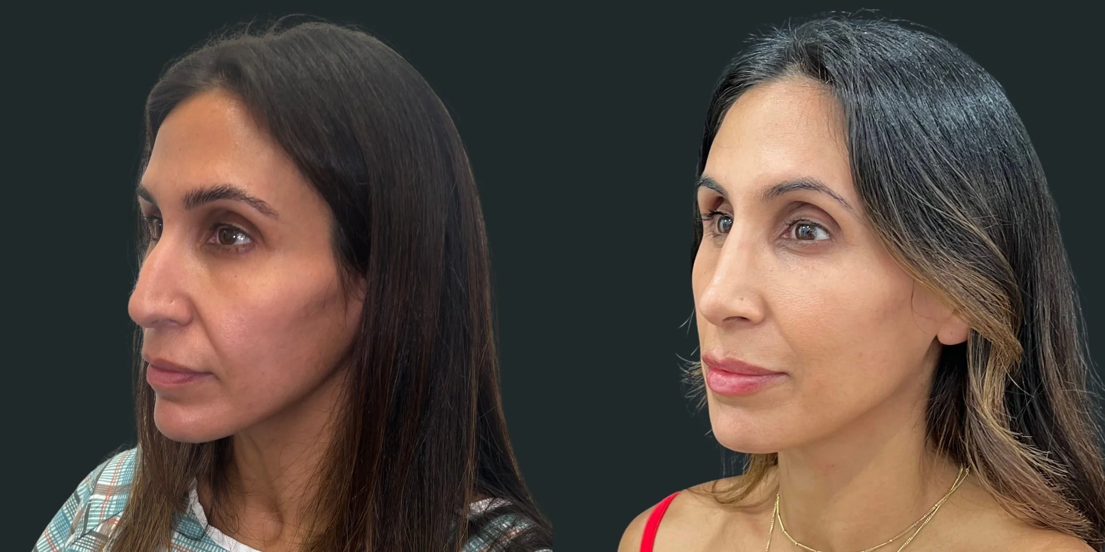 dr-michael-omidi-before-and-after-photo-of-client-rhinoplasty (2).jpg