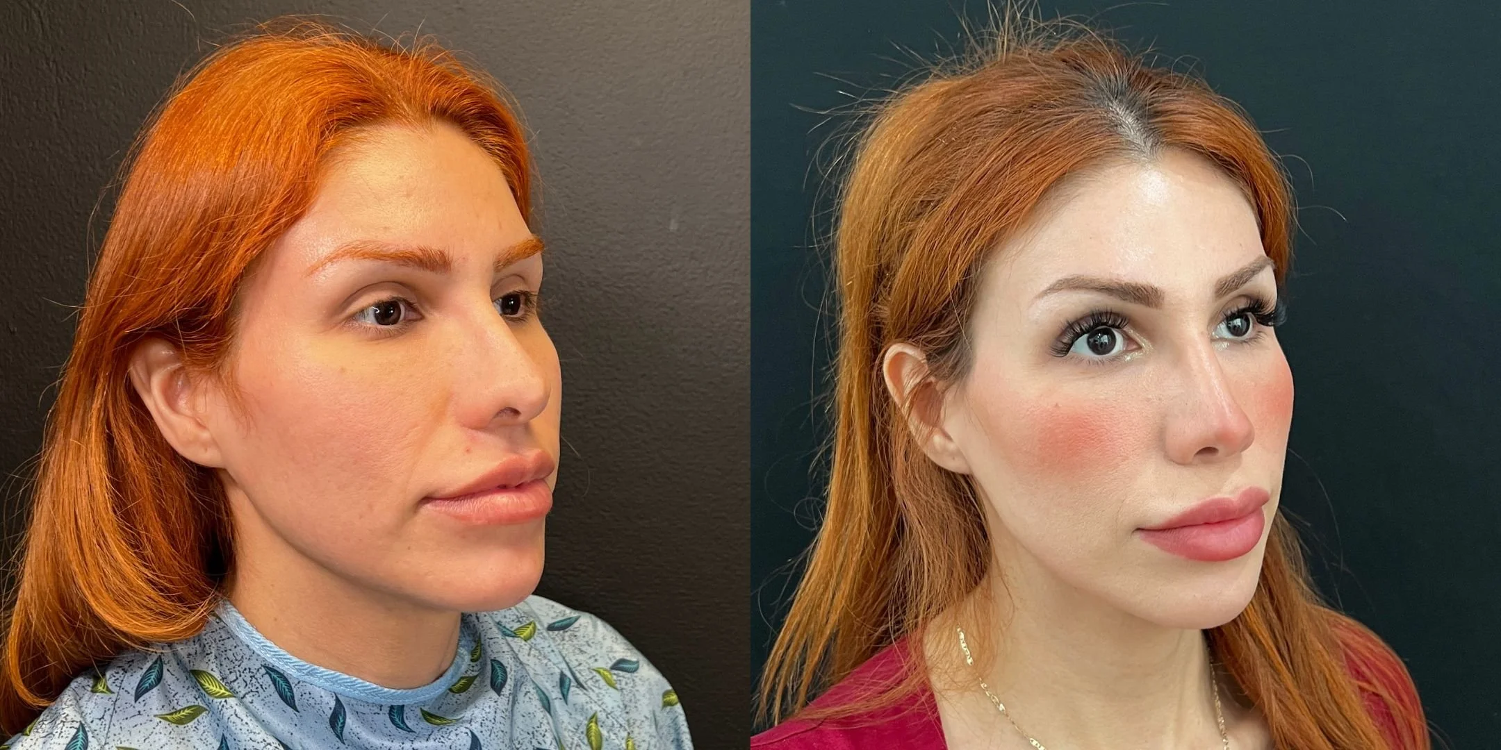 dr-michael-omidi-before-and-after-photo-of-client-revision-rhinoplasty (4).jpg