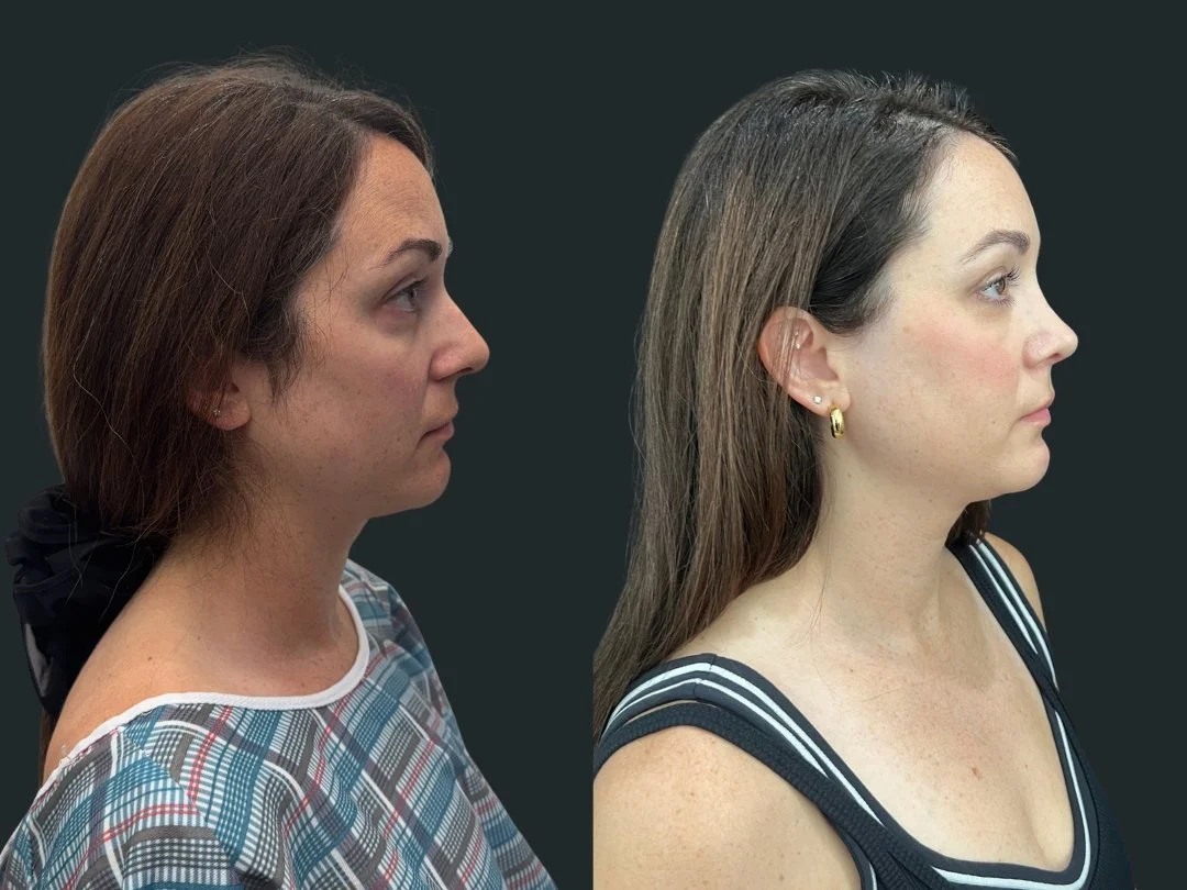 dr-michael-omidi-rhinoplasty-results-3-months-post-op- beverly-hills-california.jpg