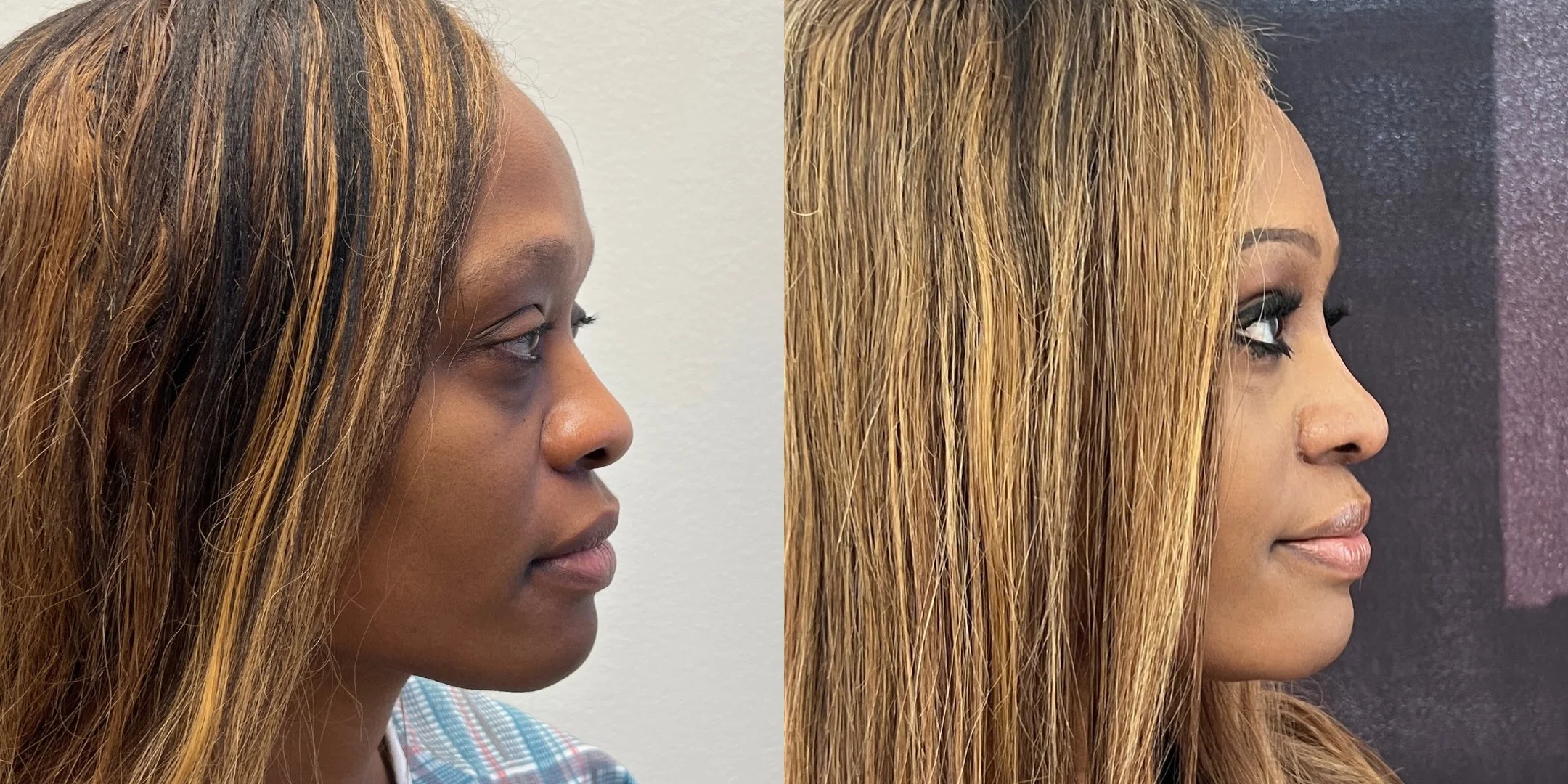 dr-michael-omidi-before-and-after-photo-of-client (5).jpg