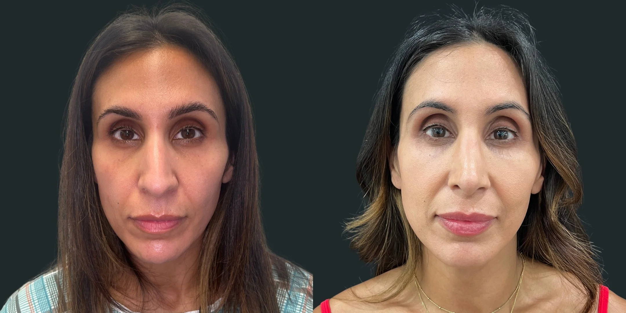 dr-michael-omidi-before-and-after-photo-of-client-rhinoplasty (3).jpg