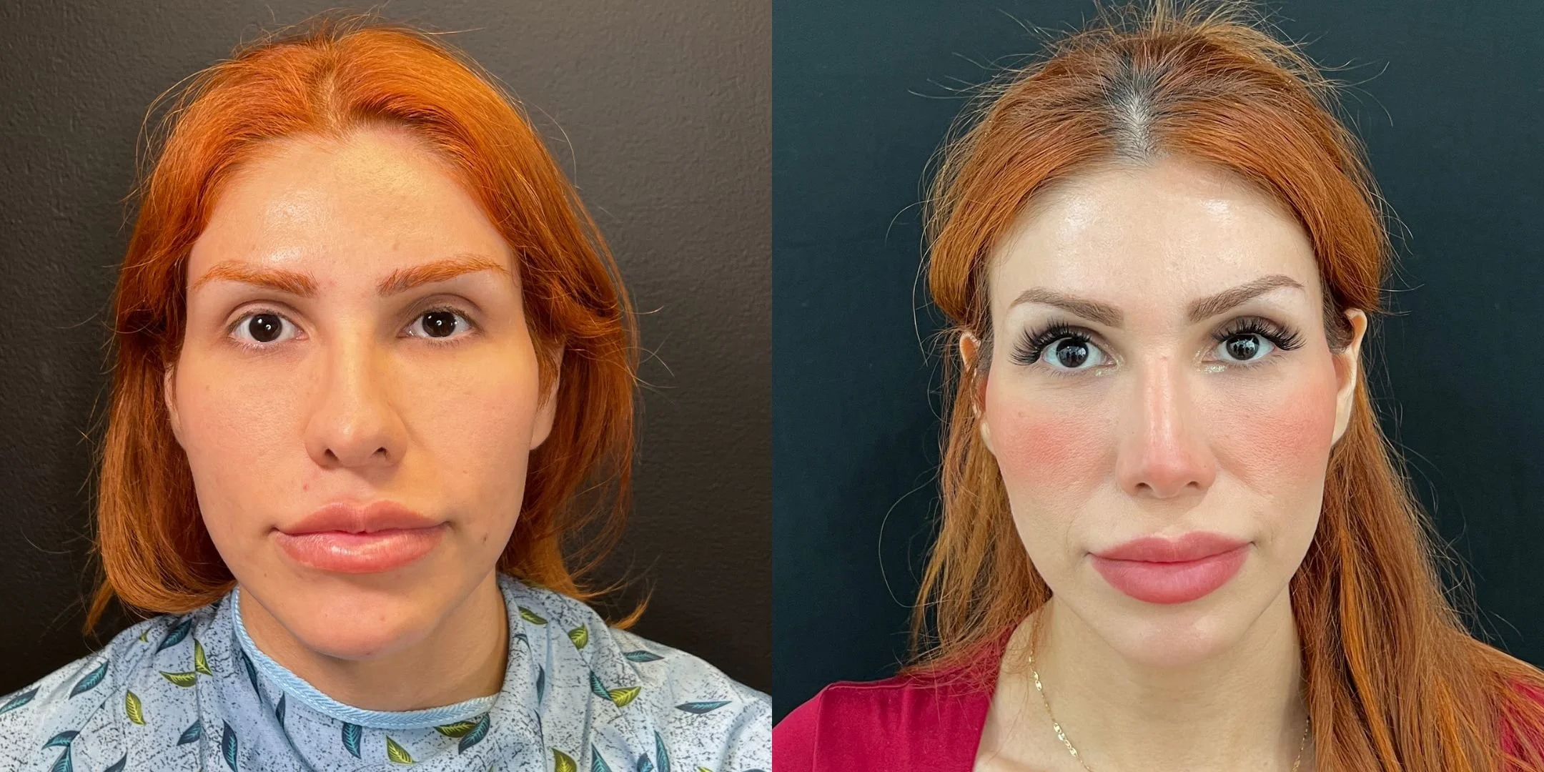 dr-michael-omidi-before-and-after-photo-of-client-revision-rhinoplasty (3).jpg
